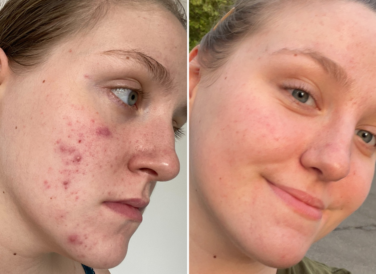 Acne on cheekbones discount