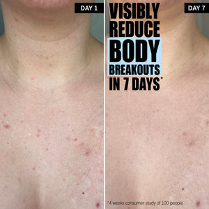 Visibly reduces body breakouts in 7 days*. The difference after 7 days.
