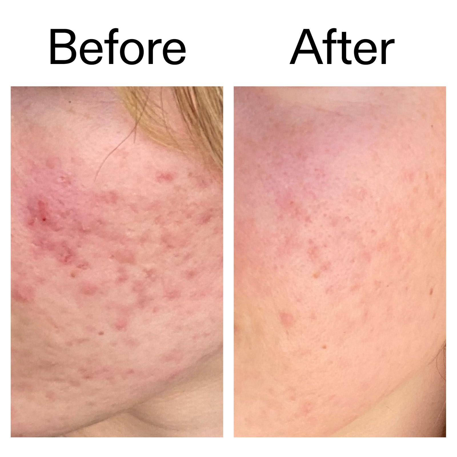 Before and after comparison of customer using Azalaic acid serum