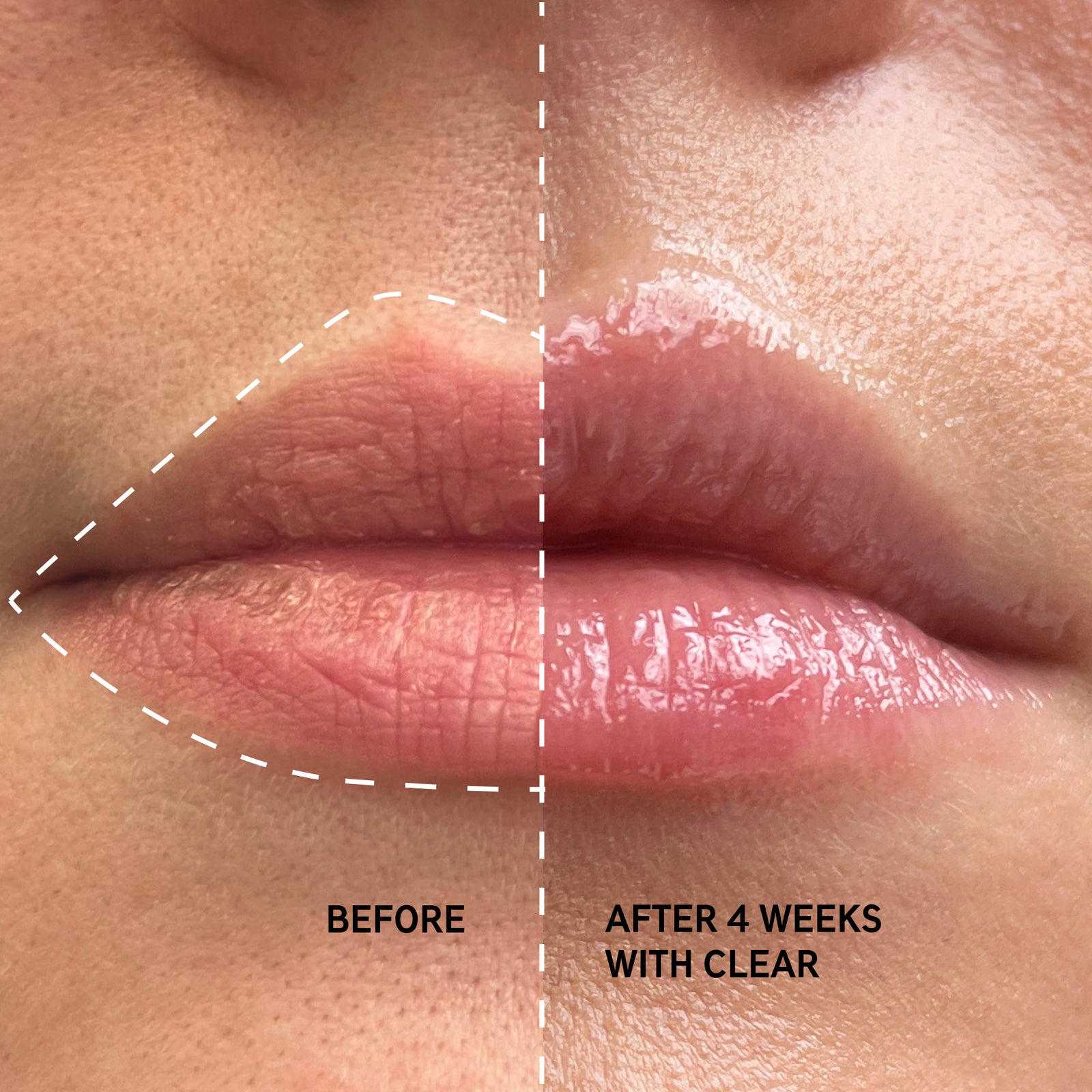 Before and after using Clear Tripeptide Lip Balm after 4 weeks showing increased volume and hydration