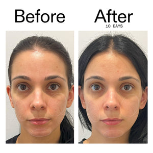 Before and after 10 days showing reduced blemish marks