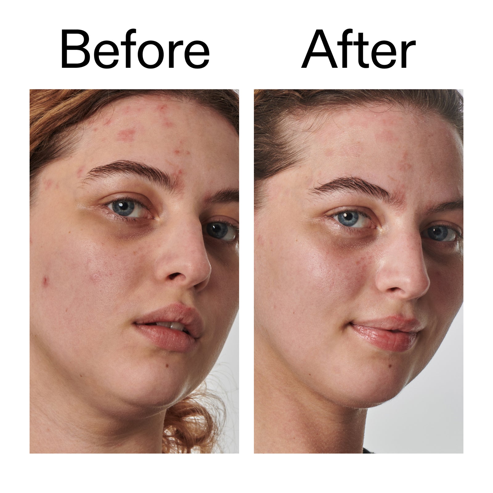 Before and after comparison of a person's face with visible acne on the left, and clearer skin on the right.