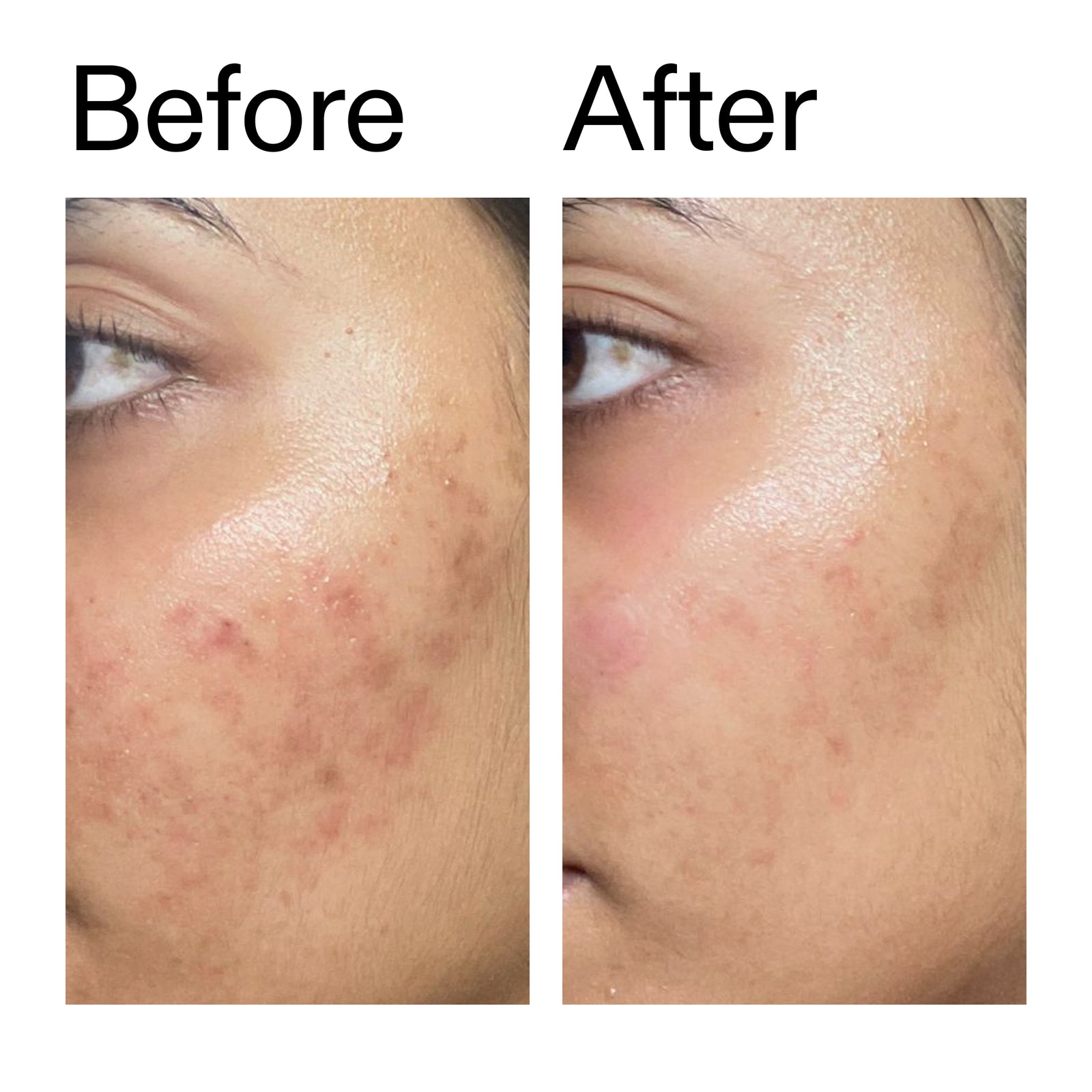 Before and after comparison of skin after using Ectoin Hydro-Barrier Serum