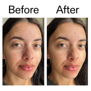 Before and after showing reduced breakouts and redness