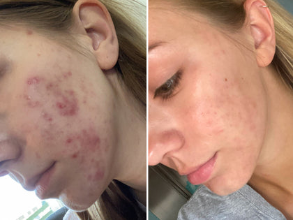 Before & after of using Hyaluronic Acid Serum