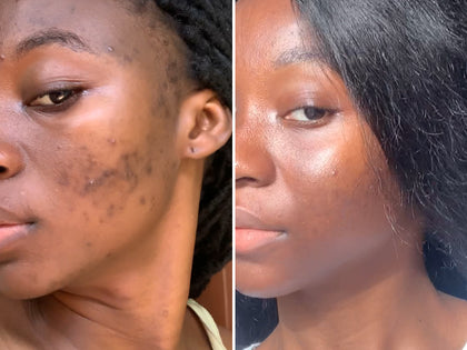 Before and after images to show a customer using Salicylic Acid Cleanser to clear her blemishes.