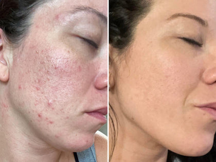 Before and after images of a customer having used The INKEY List products for 3 months to clear her skin.