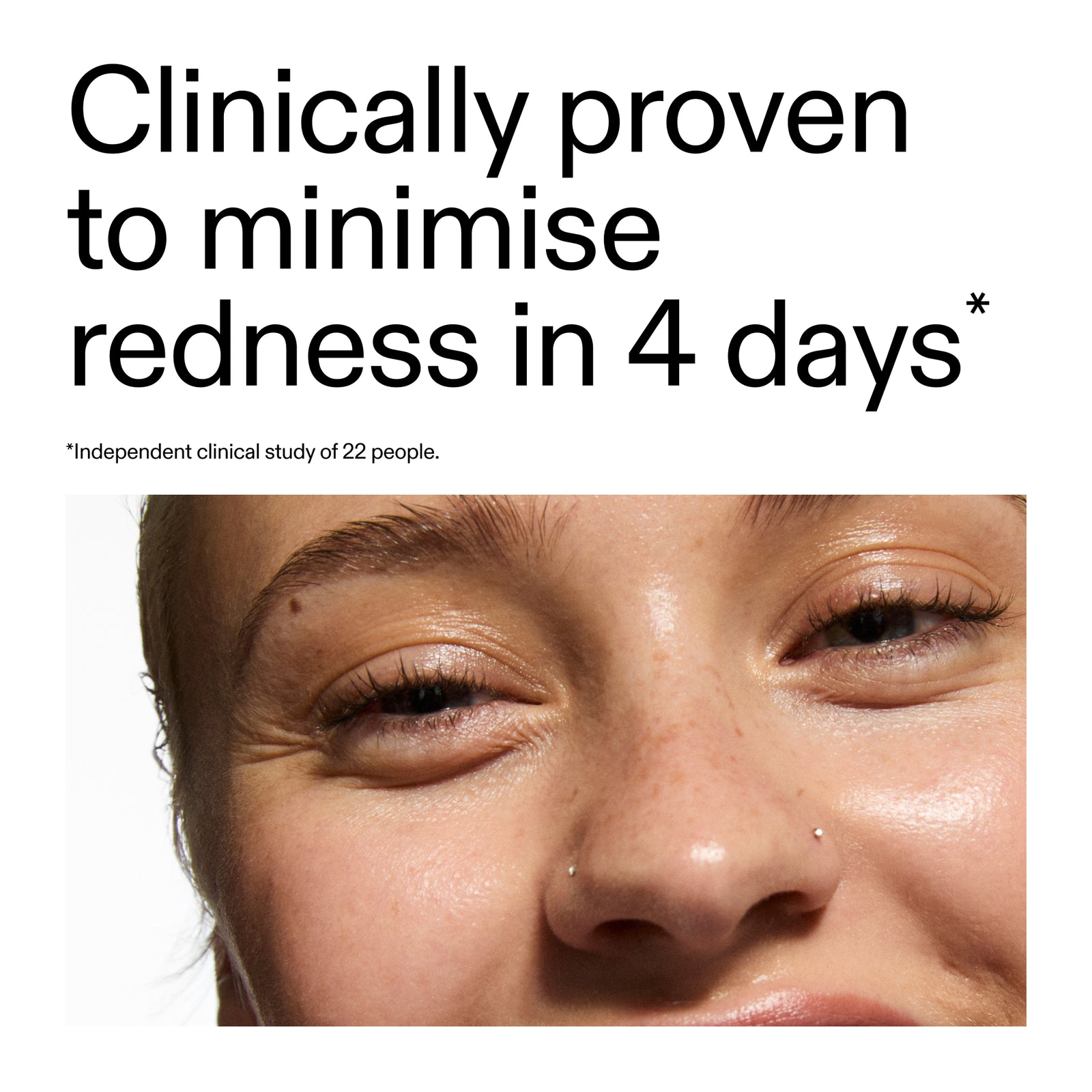 Close-up of a person's eye with text claiming clinical provenance of  Azelaic Acid Serum minimize redness in 4 days.