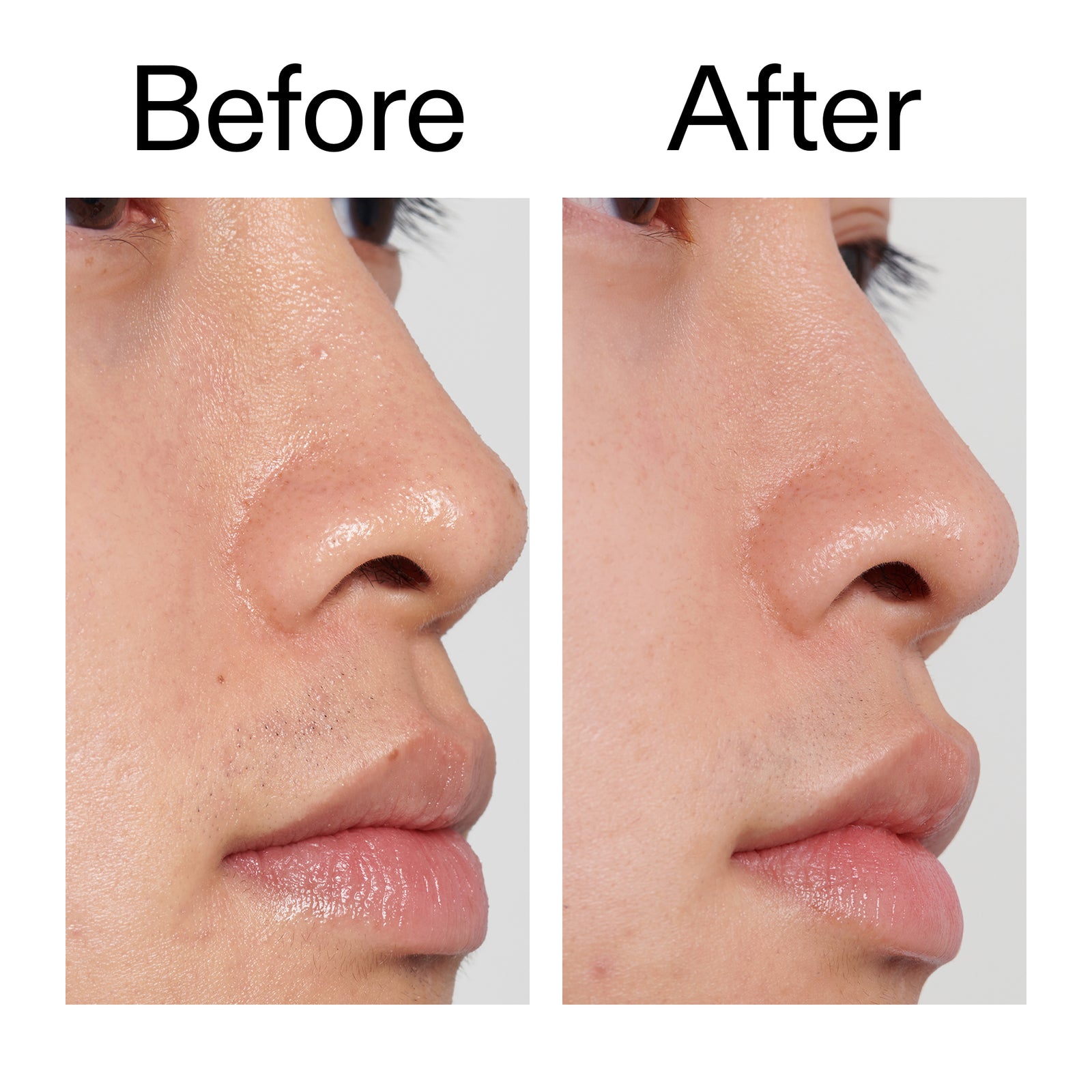 Before and after comparison of a person's nose with a clear background