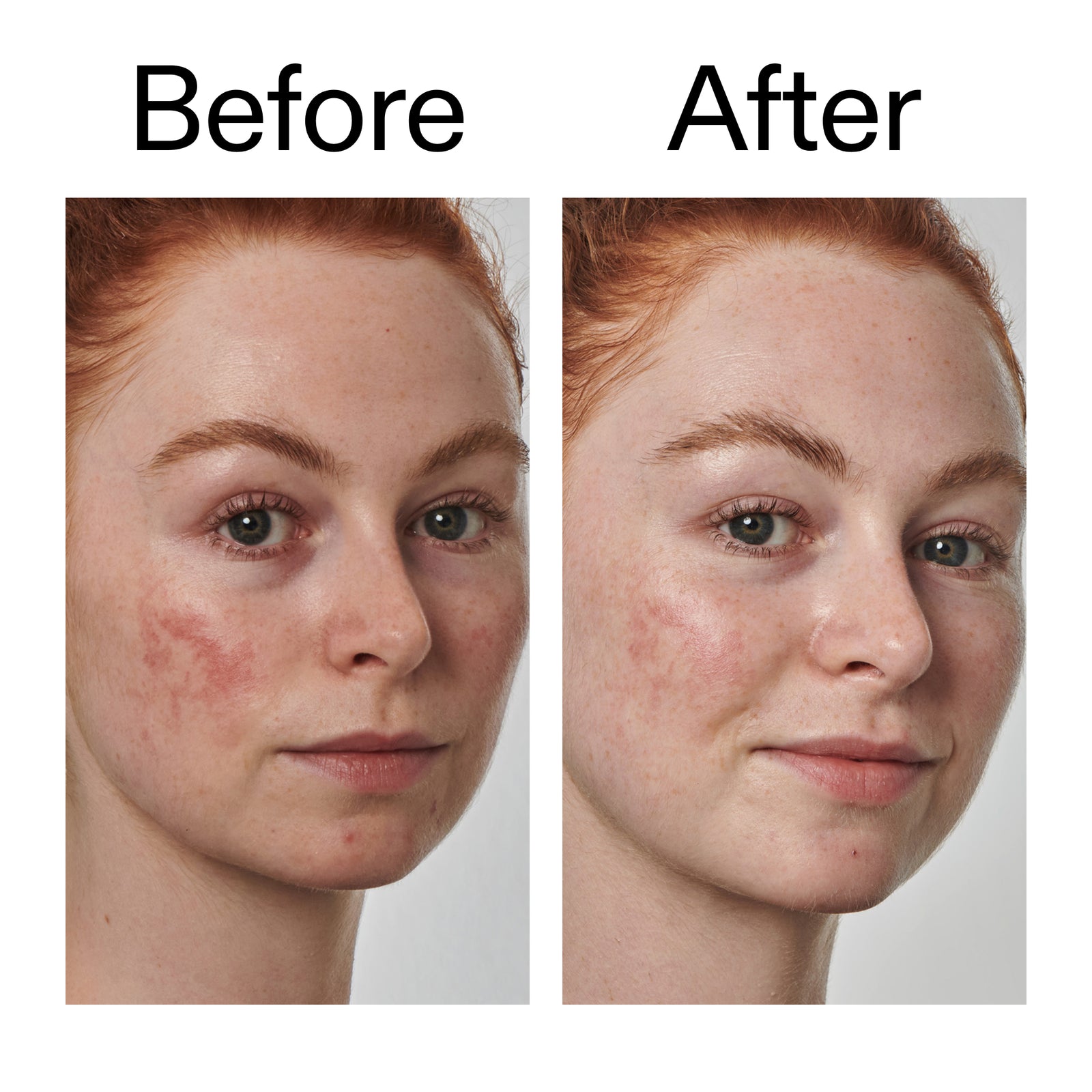 Before and after comparison of a person's face with visible skin improvement after using.  Azelaic Acid Serum