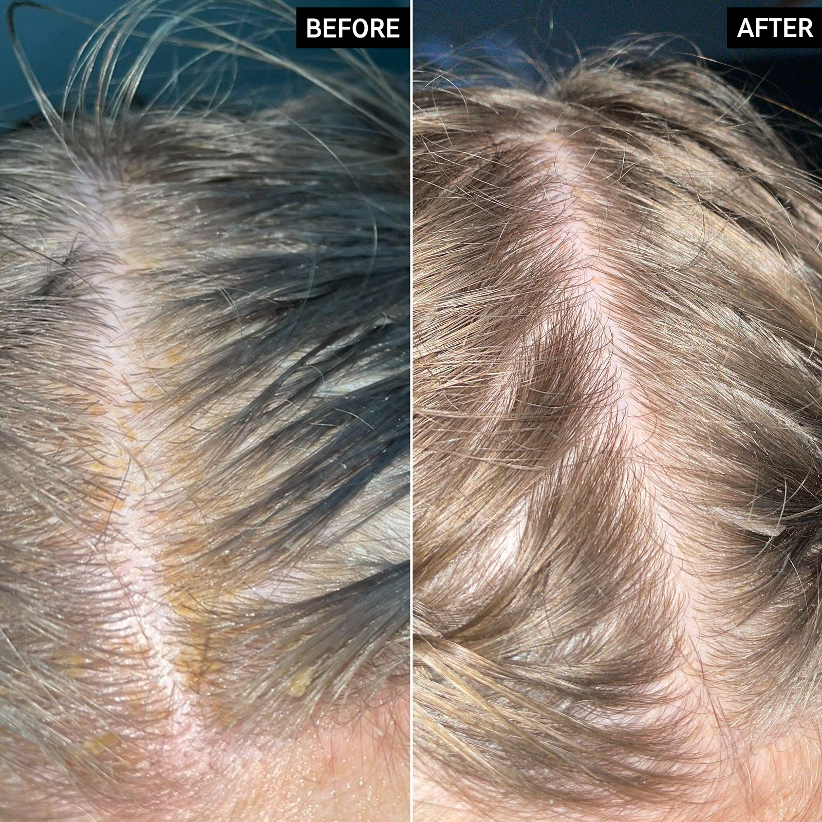 Two images of a scalp and hair side by side to show before and after using Salicylic Acid Exfoliating Scalp Treatment for 6 weeks