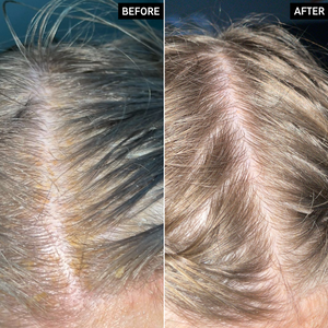 Two images of a scalp and hair side by side to show before and after using Salicylic Acid Exfoliating Scalp Treatment for 6 weeks