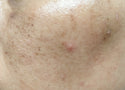 Uneven Skin Tone: What Causes It and How to Even It Out