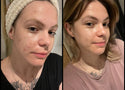Is Glycerin Good for Oily and Blemish-Prone Skin?
