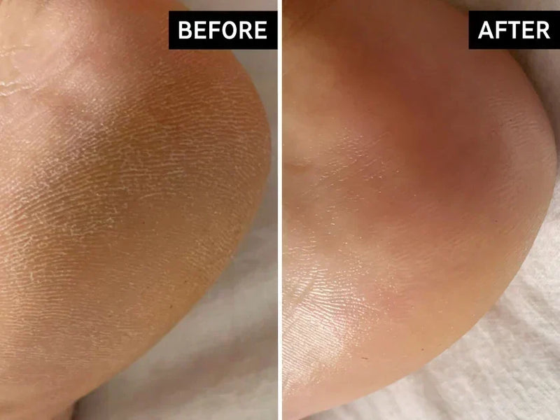 cracked heels before and after