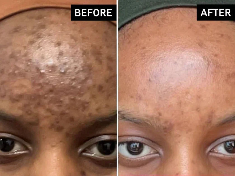 INKEY Tranexamic Acid Serum bottle beside a calendar, illustrating how long tranexamic acid takes to work on hyperpigmentation and post-blemish marks.