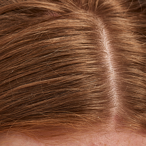close up of scalp and red hair