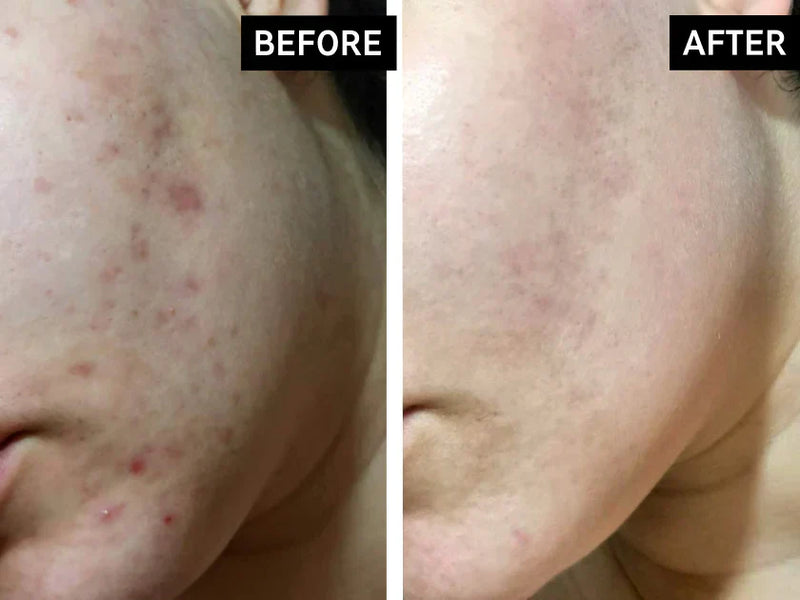 before and after acne scars