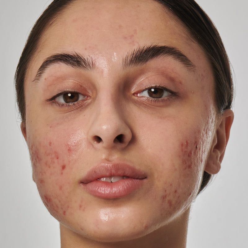 close up of woman with acne scars