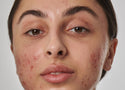 How to Get Rid of Red Acne Scars: Post-Inflammatory Erythema Explained
