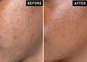 How to Get Rid of Post-Acne Dark Marks: PIH Explained