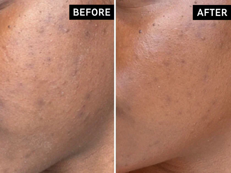 before and after of acne scars