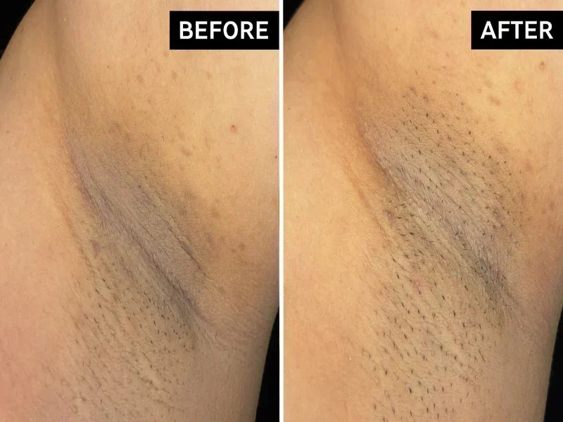 before and after under arms