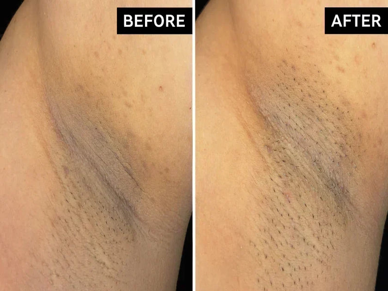before and after under arms