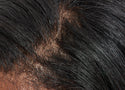 How to prevent hair loss and thinning hair