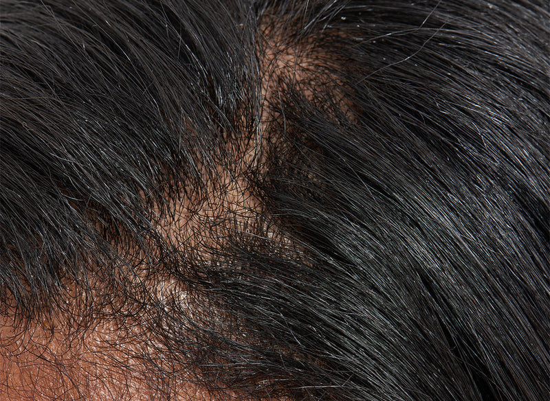 Close up of thinning hair on a scalp