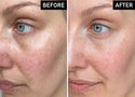 What is Melasma & How to Treat It