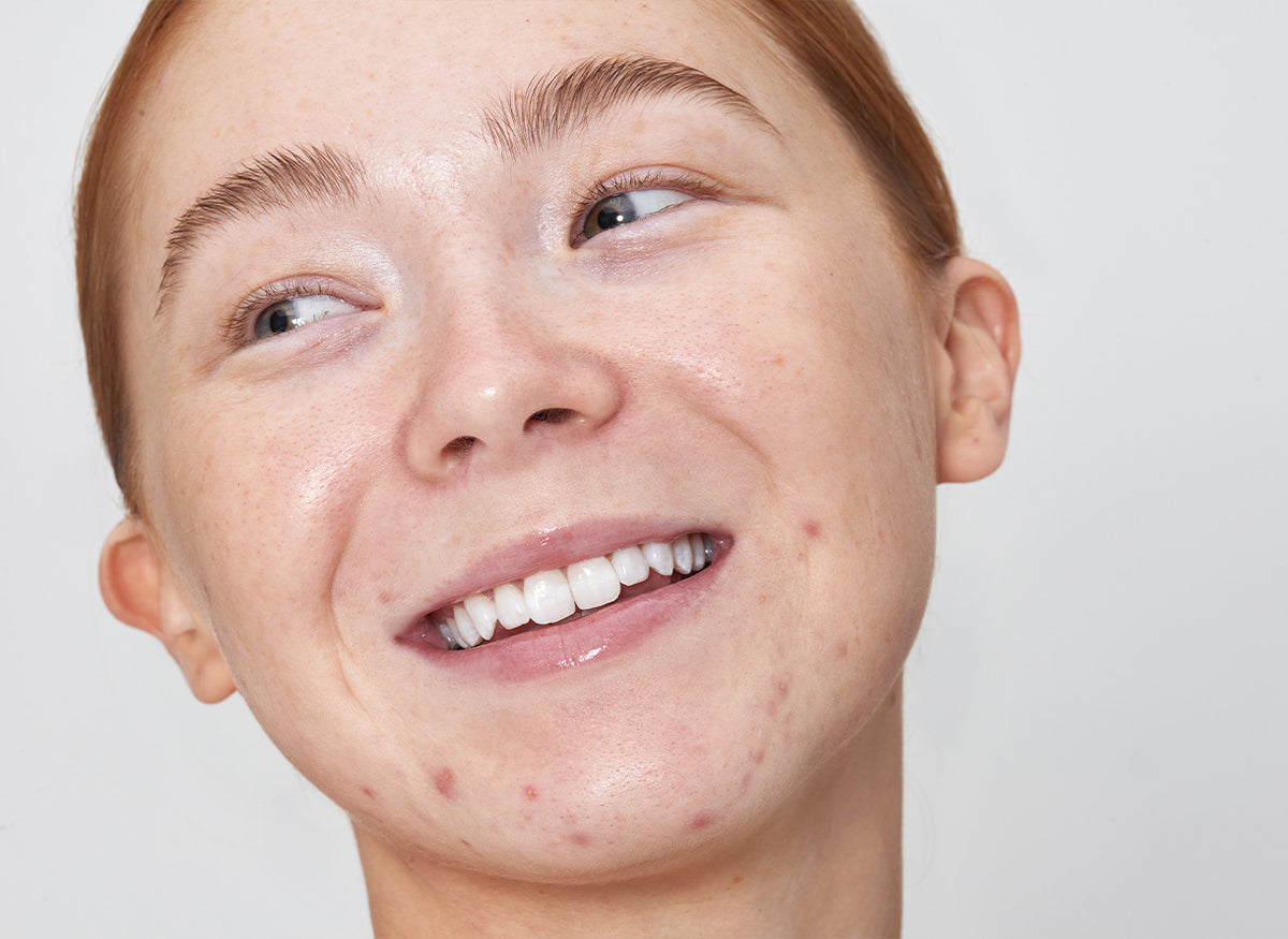How to Reduce and Prevent Redness | The INKEY List