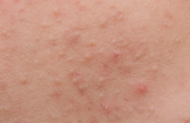 fungal acne close up