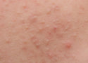 What Is Fungal Acne? Symptoms, Causes and How to Treat It