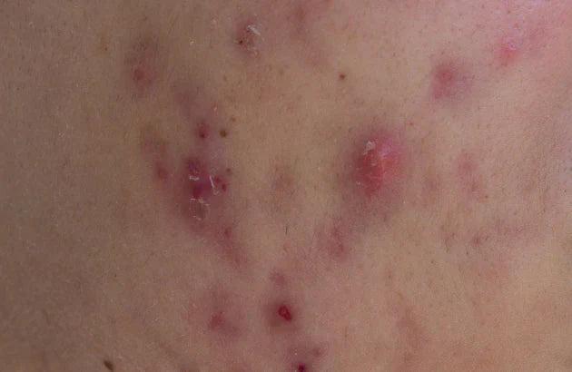close up of cystic acne