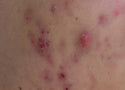 Cystic Acne: What It Is, What Causes It, and How to Treat It