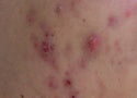 Cystic Acne: What It Is, What Causes It, and How to Treat It