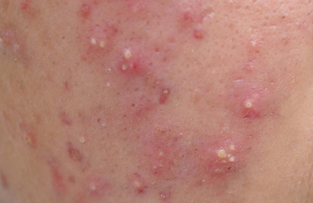 close up of pustules