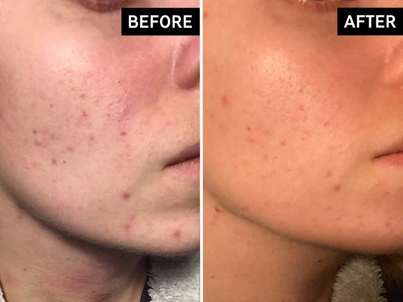 before and after using glycolic acid
