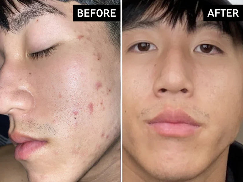 before and after of man using HA serum