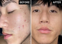 Is Hyaluronic Acid Good for Acne-Prone Skin? Everything You Need to Know
