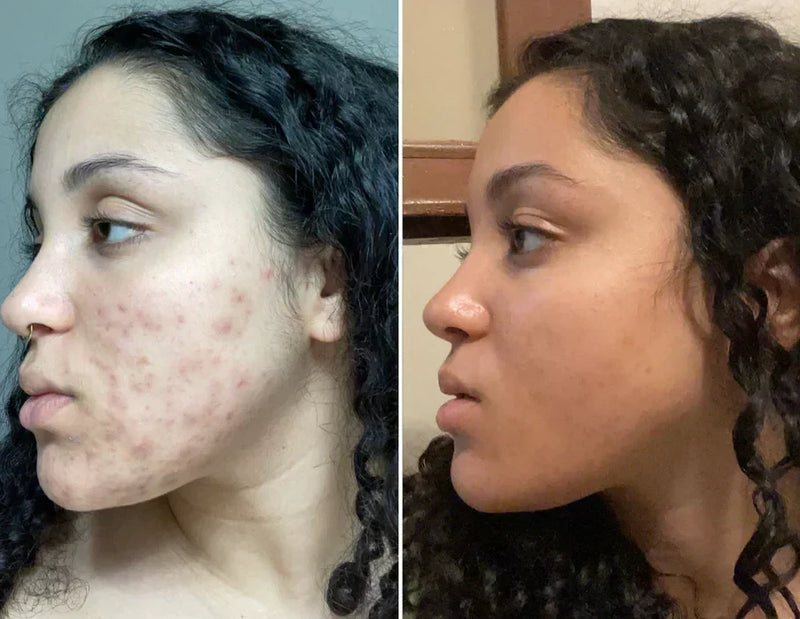 Before and after acne scarring