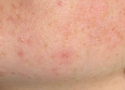 Does Azelaic Acid Cause Purging? What Your Skin Is Telling You