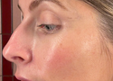 PDRN Injections vs Topical PDRN: What’s the Difference and Which Is Right for You?