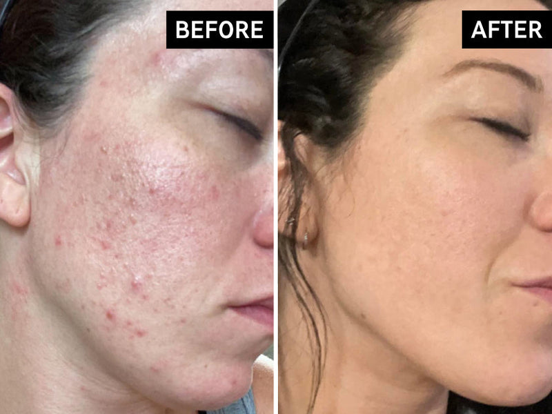 before and after using niacinamide