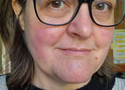 Azelaic Acid for Rosacea-Prone Skin: Does It Actually Work?