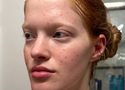 Does Niacinamide Help With Acne? The Science-Backed Answer