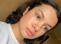 Ectoin for Rosacea-Prone Skin: The Barrier-First Approach That Actually Works