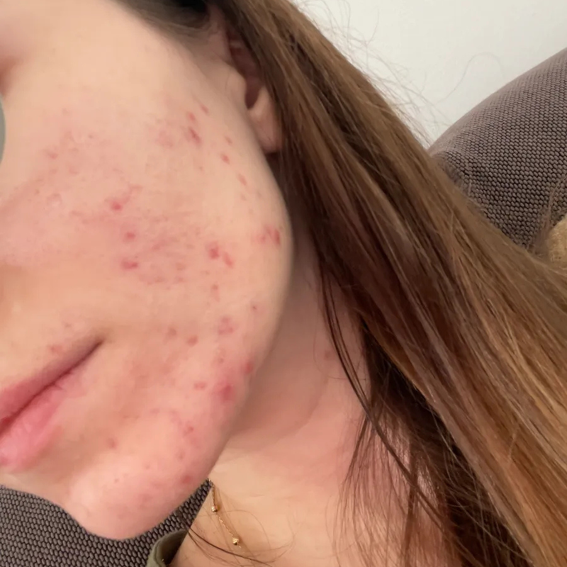 acne on face