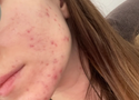 Sensitive Skin and Breakouts: How to Treat Without Stripping
